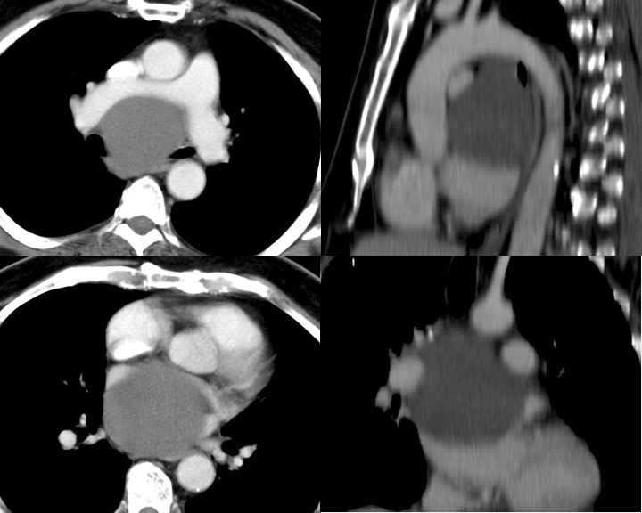 Bronch Cyst 1 CT
