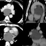 Bronch Cyst 1 CT
