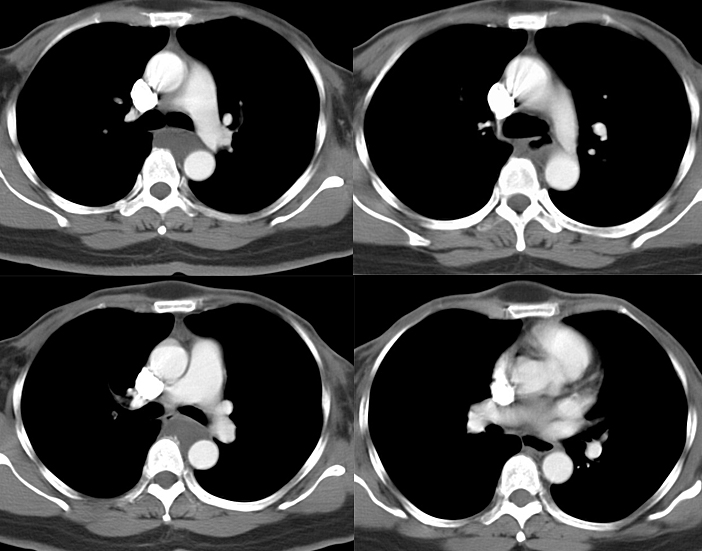 Bronch Cyst 2 CT
