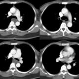 Bronch Cyst 2 CT
