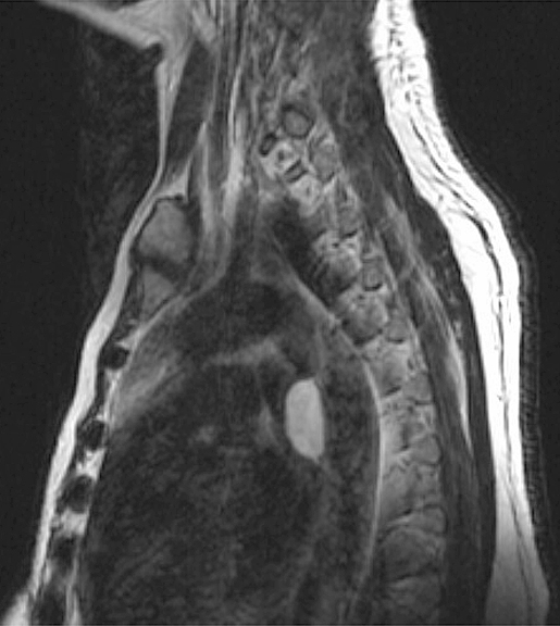 Bronch Cyst 2
MR sagitt