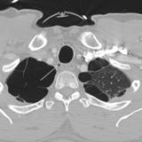 tracheal diverticulum