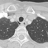 tracheal diverticulum 2