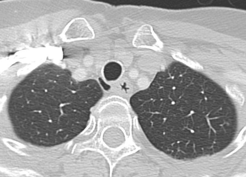 tracheal diverticulum 2