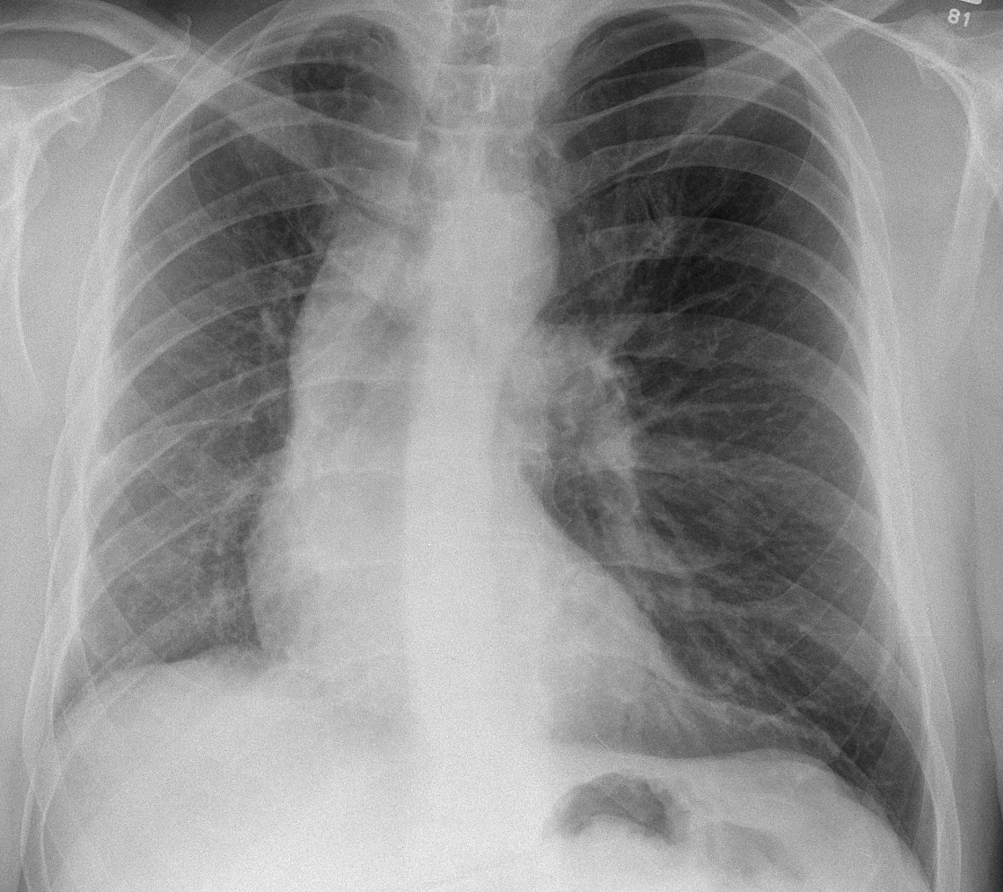 Hypoplastic right lung