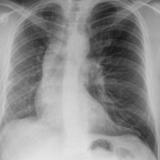 Hypoplastic right lung
