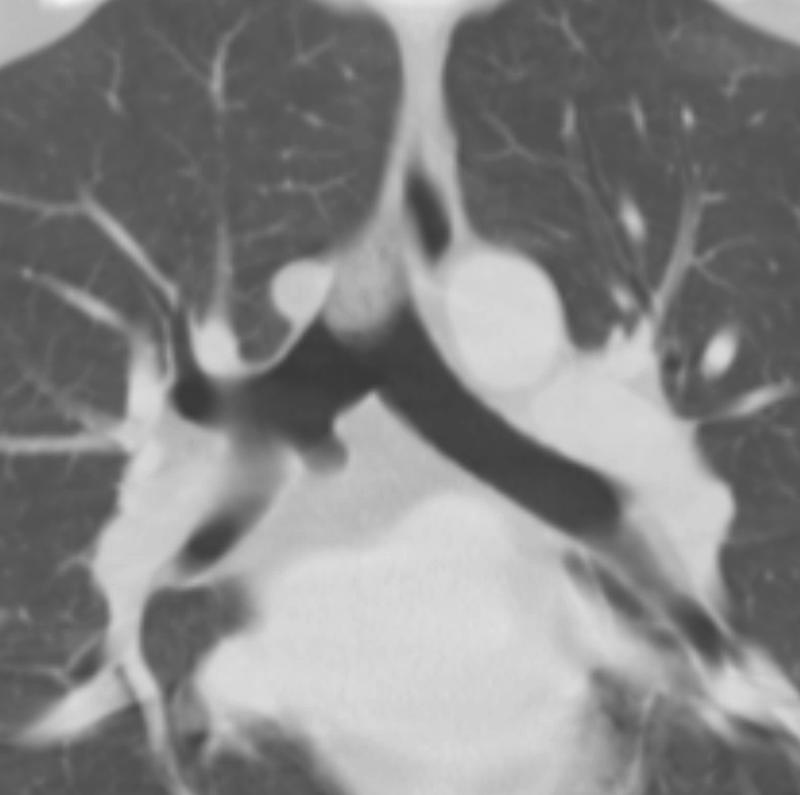 cardiac bronchus - and plug