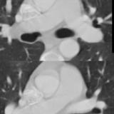 cardiac bronchus axial