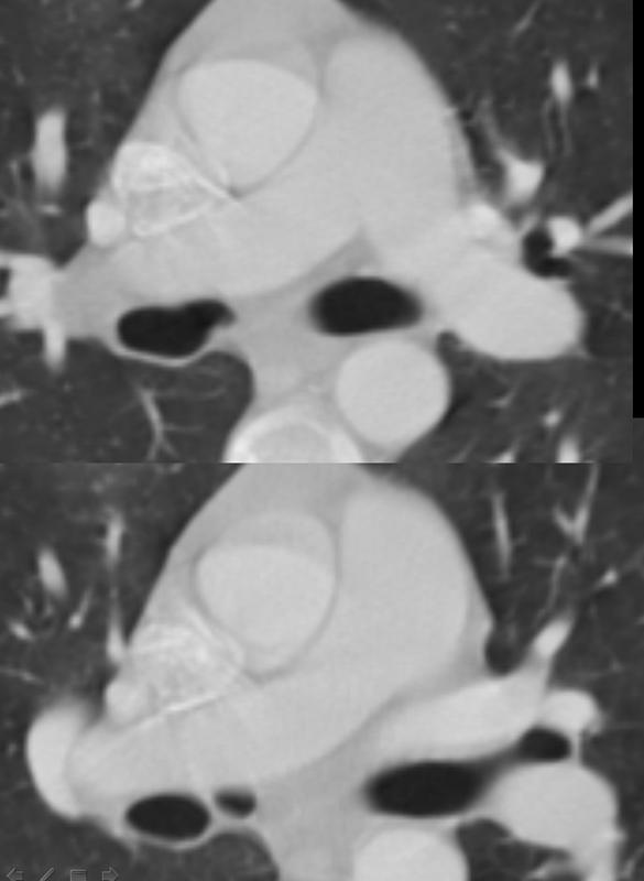 cardiac bronchus axial