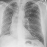Hypoplastic Rt lung