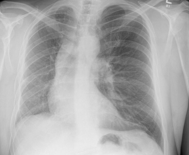 Hypoplastic Rt lung