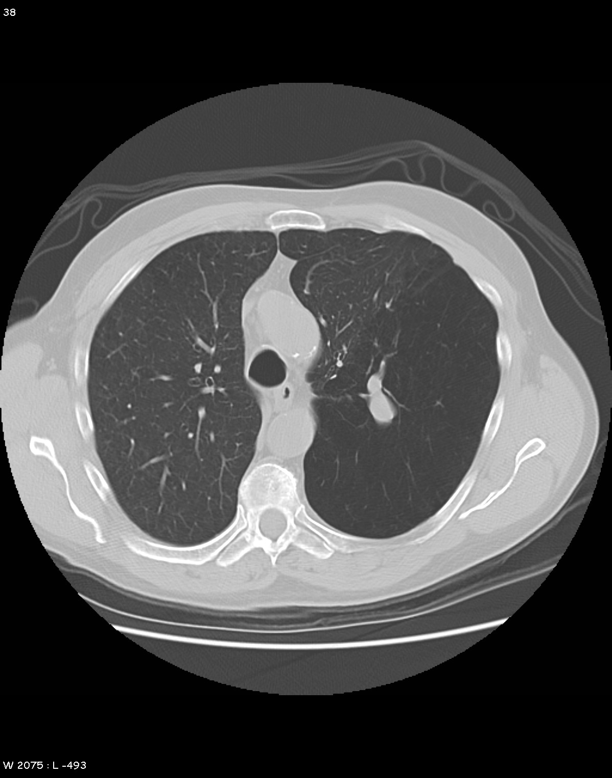 Bronchial atresia CT