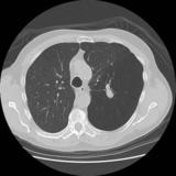 Bronchial atresia CT