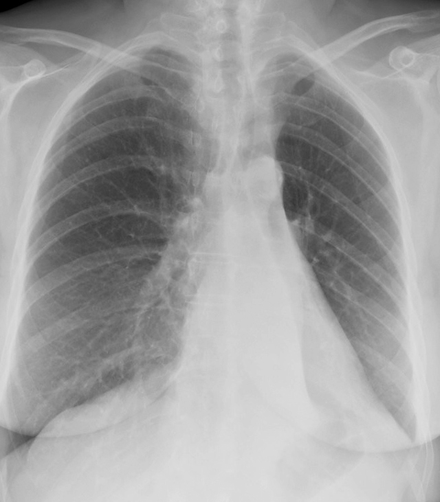 LLL Collapse Case 1 PA