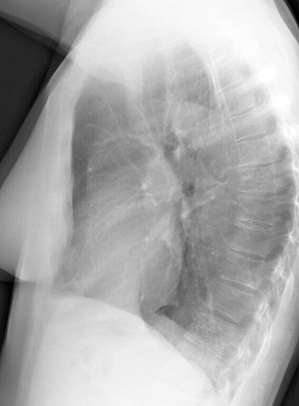 LLL Collapse Case 2 Lateral