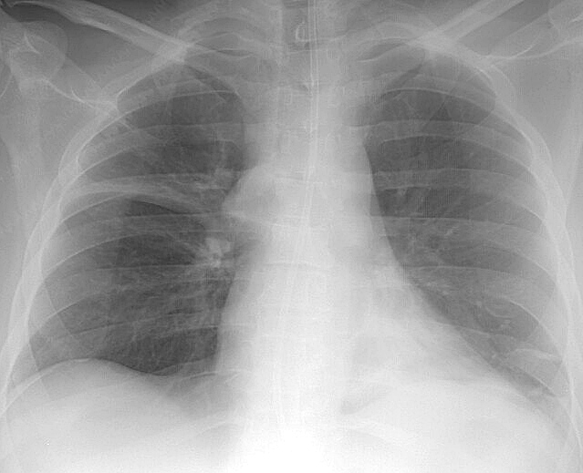 LLL Collapse Case 3a PA