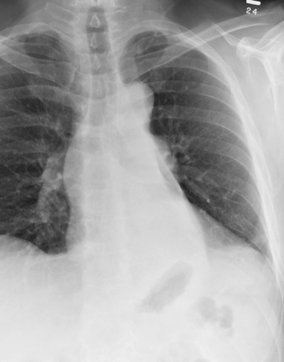 LLL Collapse Case 4 PA