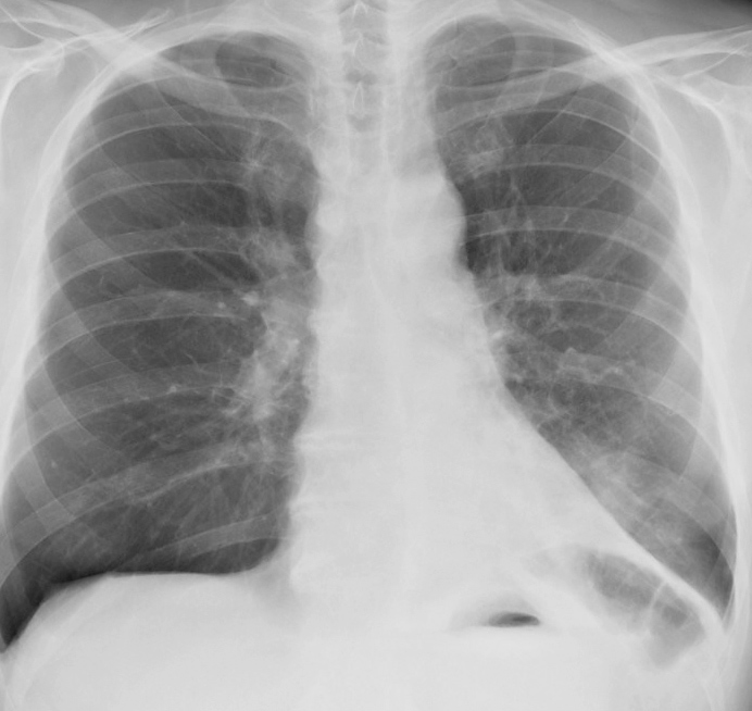 LLL Collapse Case 5 PA