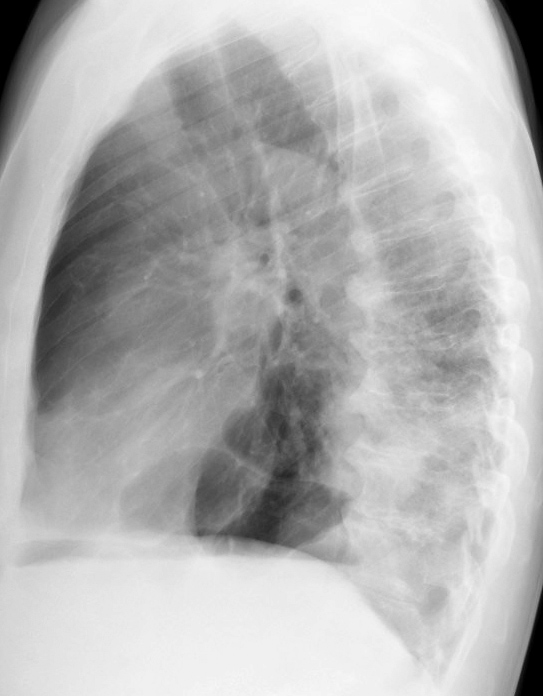 LLL Collapse Case 5 Lateral