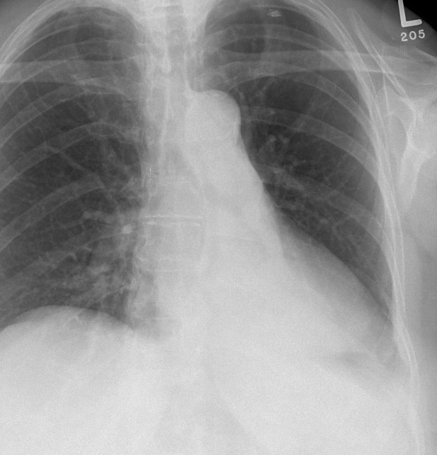 LLL Collapse Case 6 PA