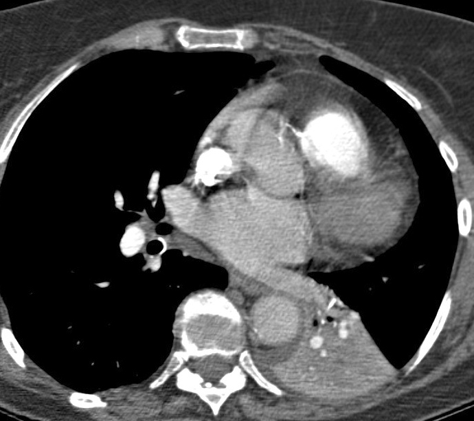 LLL Collapse Case 6 CT