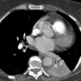 LLL Collapse Case 6 CT