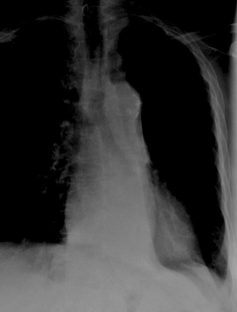 LLL Collapse Case 7 PA