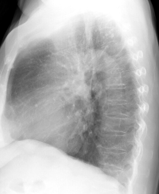 LLL Collapse Case 7 Lateral