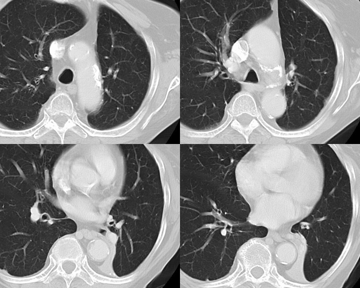 LLL Collapse Case 7 CT