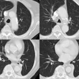 LLL Collapse Case 7 CT