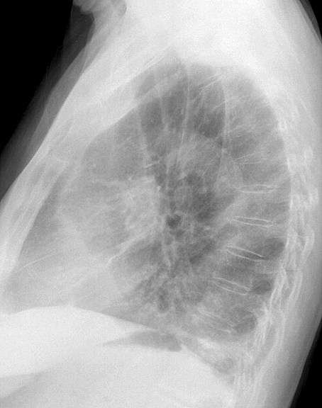 LLL Collapse Case 8 Lateral