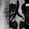 paratracheal "stripe"