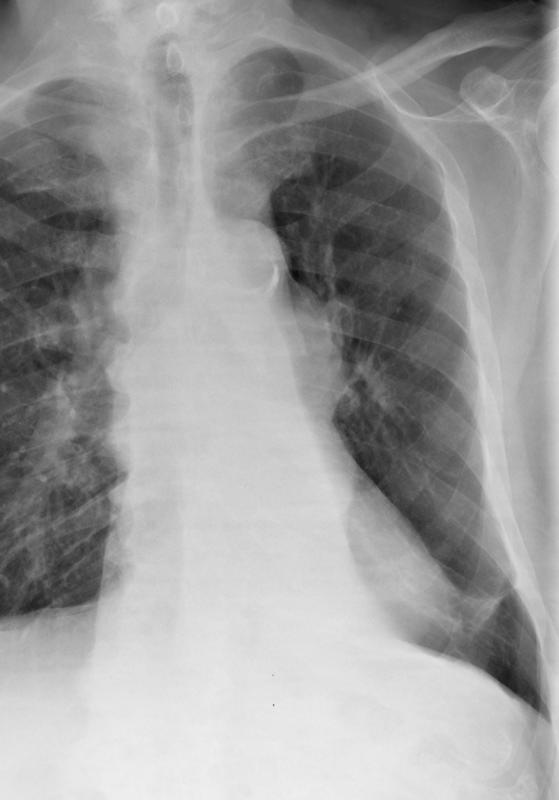 LLL collapse
Hilar mass  Case 10