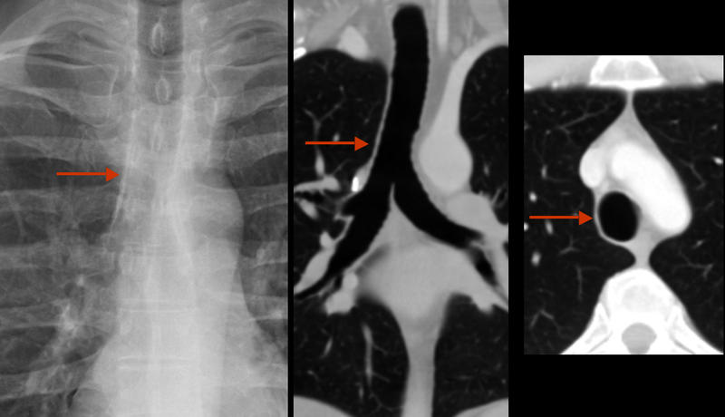 paratracheal "stripe"