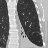 LLL collapse Case 11 Coronal CT