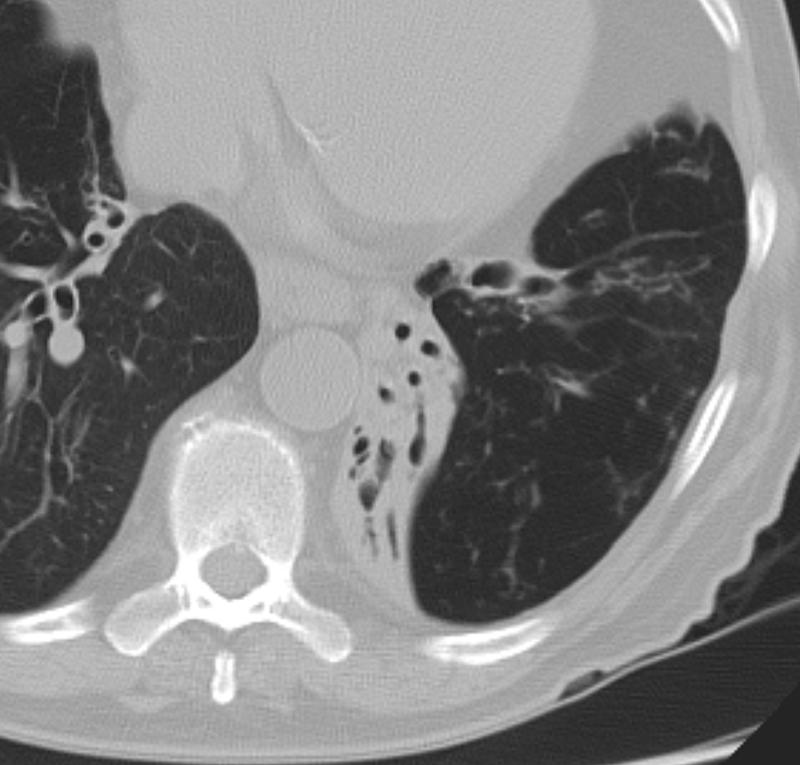 LLL collapse Case 11 axial CT