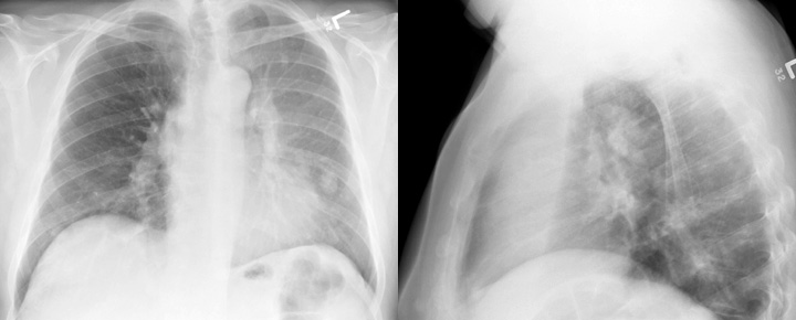 LUL Collapse Case 1 PA and Lateral