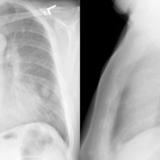 LUL Collapse Case 1 PA and Lateral