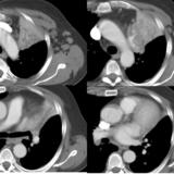 LUL Collapse Case 1 CT 4in1