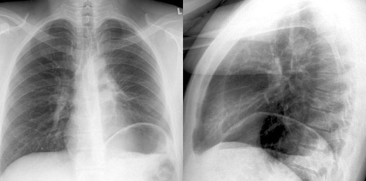 LUL Collapse Case 4 PA and Lateral