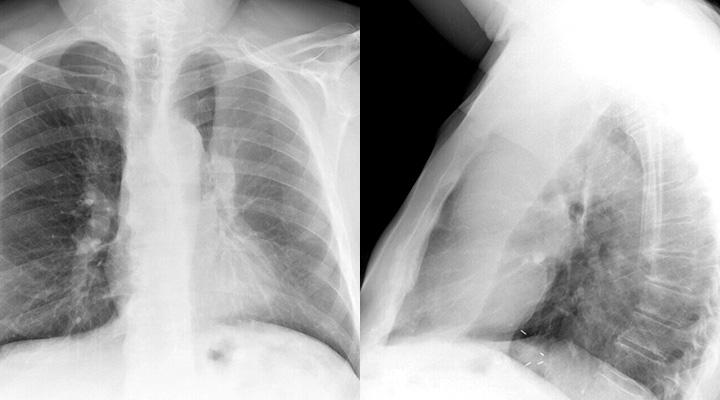 LUL Collapse Case 5 PA and Lateral