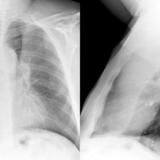 LUL Collapse Case 5 PA and Lateral