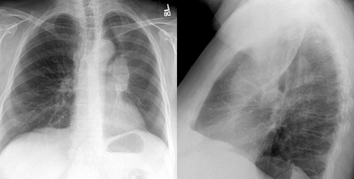 LUL Collapse Case 7 PA and Lateral