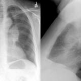 LUL Collapse Case 7 PA and Lateral