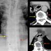 paraspinal lines