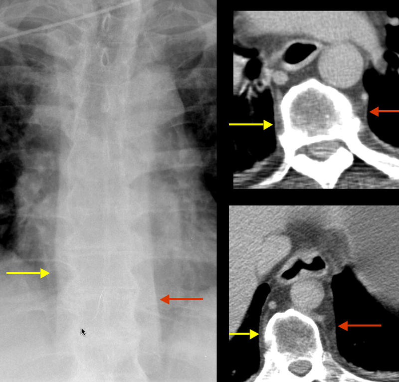 paraspinal lines