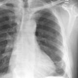 Rounded atelectasis case 1