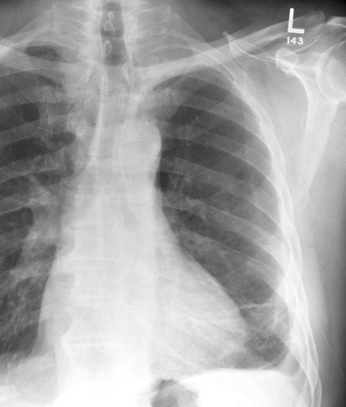 Rounded atelectasis case 1