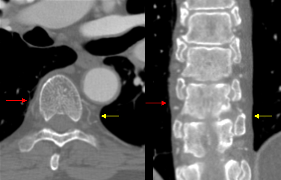 Paraspinal lines