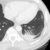 Rounded atelectasis case 1 CT